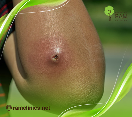 الفرق-بين-الدمامل-والخراج