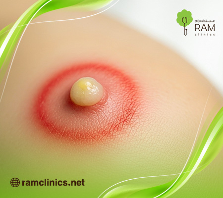 الفرق-بين-الدمامل-والخراج