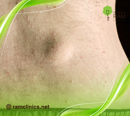 ما-هو-الورم-الشحمي