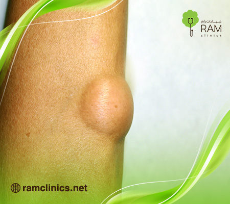 شكل-الورم-الشحمي