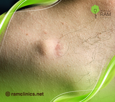 أعراض-الورم-الشحمي-الخبيث