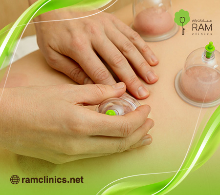 الحجامة-للقولون-العصبي