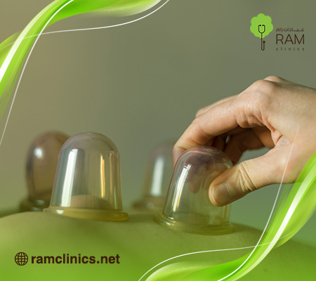 الحجامة-للقولون-العصبي