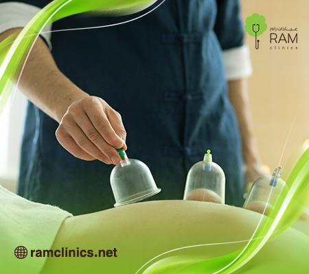 الحجامة-للقولون-العصبي