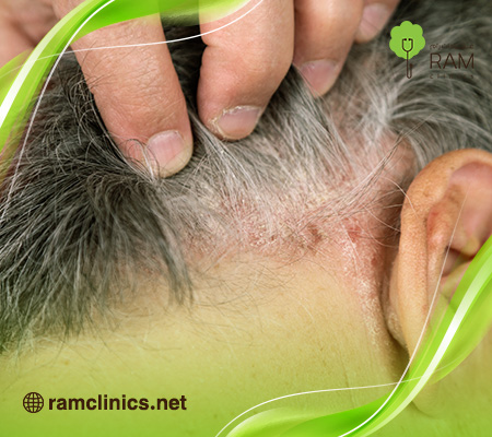 علاج- صدفية-الراس