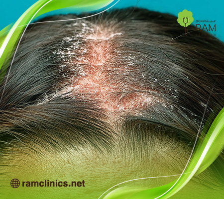 علاج- صدفية-الراس