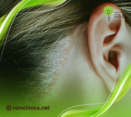 علاج- صدفية-الراس