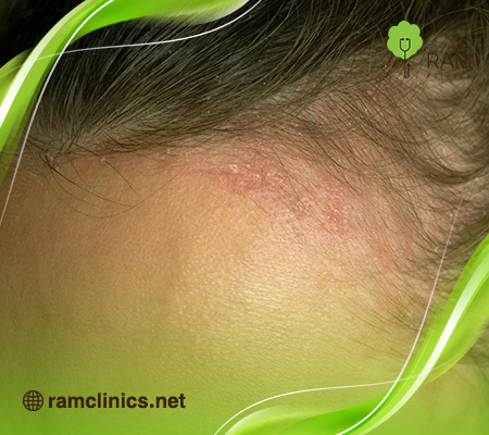 علاج- صدفية-الراس