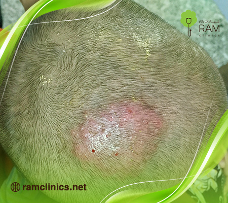 مرض-هربس-الجلدي