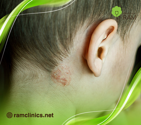 مرض-هربس-الجلدي