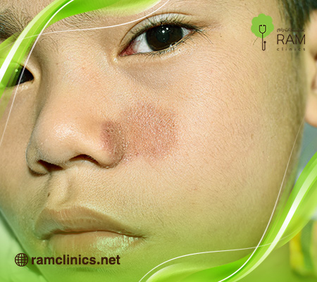 مرض-هربس-الجلدي