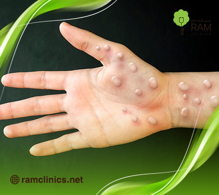 فقاعات-الجلد 