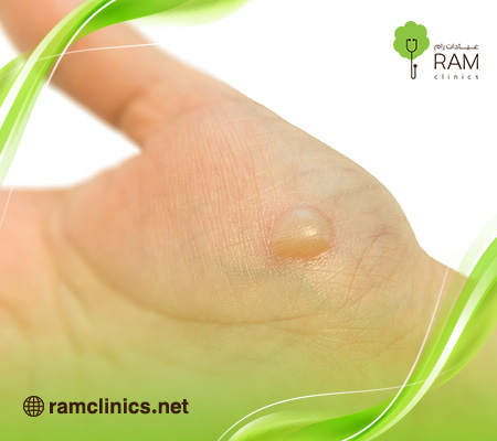 فقاعات-الجلد 