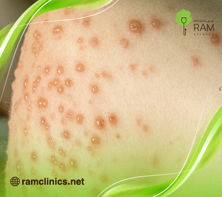 فقاعات-الجلد 