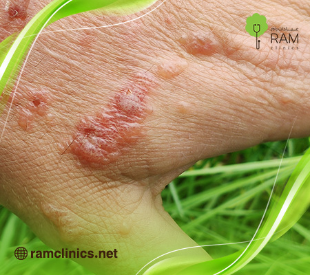 فقاعات-الجلد 