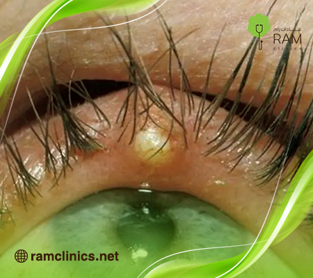 جفن-العين-الأبيض