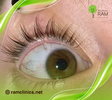 جفن-العين-الأبيض