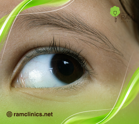 رأرأة-العين