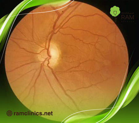 ماهو-الضمور