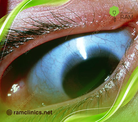 علاج-الضمور-البصري