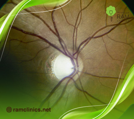 تكلفة-علاج-الضمور-البصري