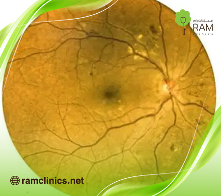 علاج-الشبكيه