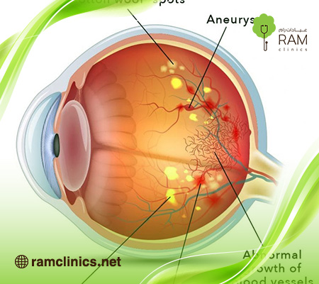 علاج-تلف-شبكية-العين