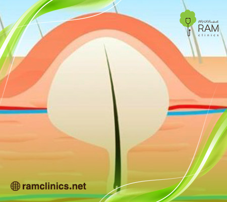 شكل-الناسور-في-بدايته