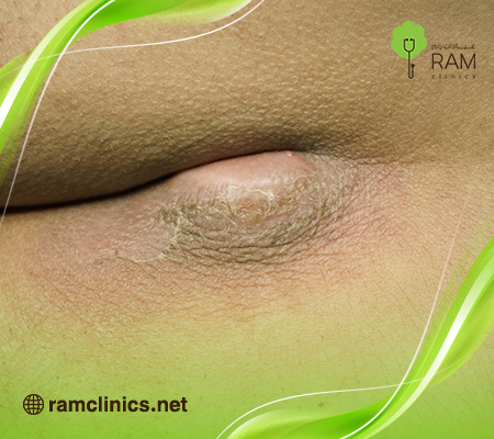 اعراض-الناسور-العصعصي