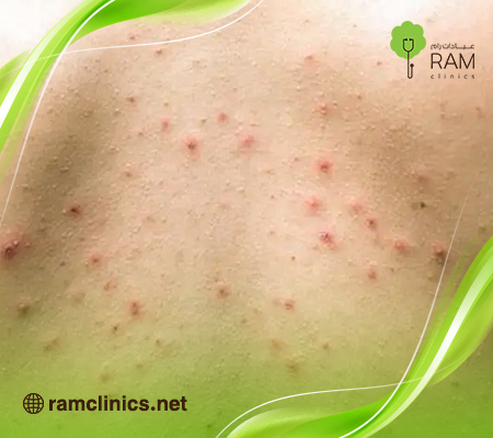 حبوب-صغيره-بالجسم