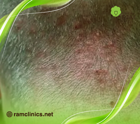 حبوب-فروة-الراس