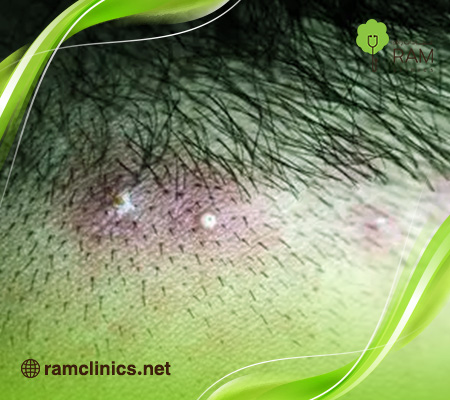 اسباب-ظهور-حبوب-في-فروة-الراس