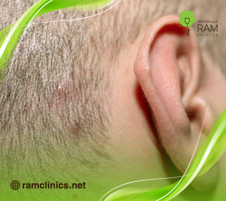 أنواع-حبوب-فروة-الرأس