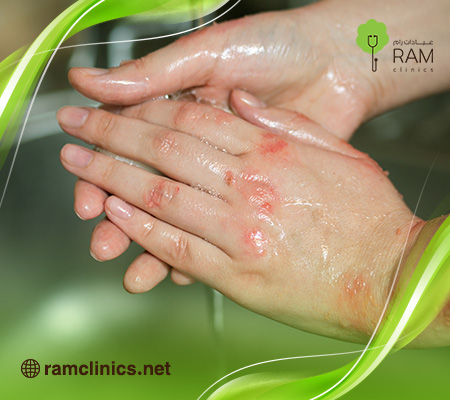 علاج-الحروق-في-المنزل