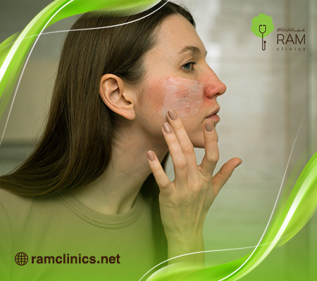 كريم-علاج-الحروق