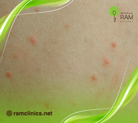 أسباب-ظهور-حبوب-في-المؤخرة-عند-النساء