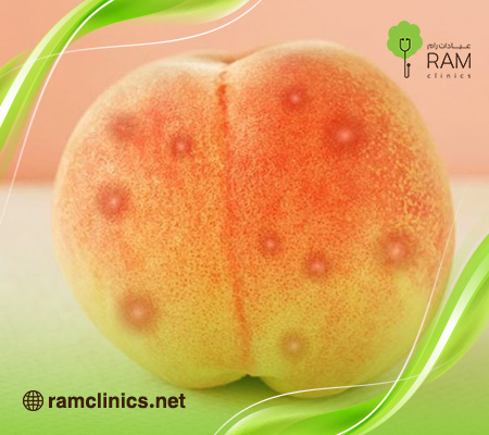 أسباب-ظهور-حبوب-في-المؤخرة-عند-النساء