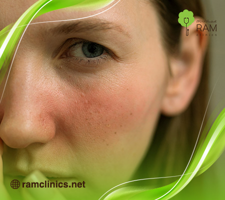 ماسك-لحروق-الشمس