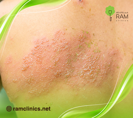 اعراض-الحزام-الناري-في-البطن