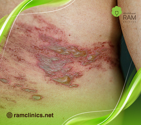 علاج-الحزام-الناري