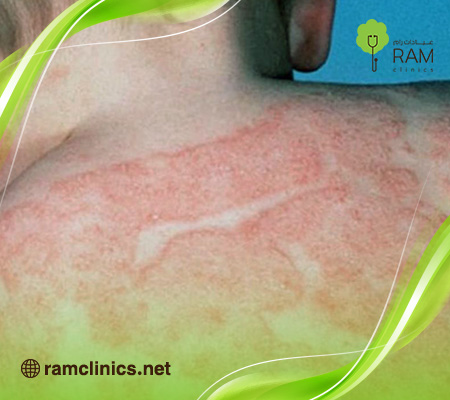 علاج-الحزام-الناري-في-الظهر