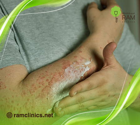 أسرع-طريقة-لعلاج-الحزام-الناري