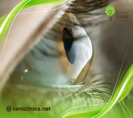 ما-هى-القرنية-المخروطية