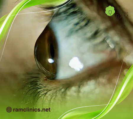 أسباب-القرنية-المخروطية