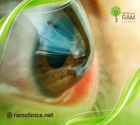 أعراض-القرنية-المخروطية