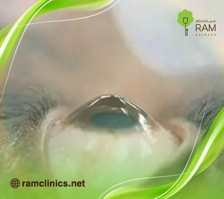 علاج-القرنية-المخروطية