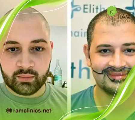زراعة-اللحية-قبل-وبعد