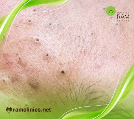اسباب-البثور-السوداء-في-الوجه