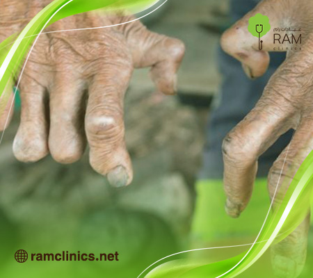 أعراض-مرض-الجذام 