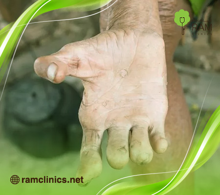 اسباب-مرض-الجذام-و-انواعه